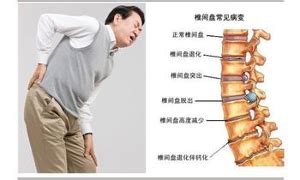 腰痛的原因有哪些 腰疼是什么原因引起的-百度经验