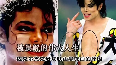 迈克尔杰克逊皮肤由黑变白的原因，被误解的伟大人生_腾讯视频