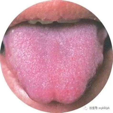 舌诊，非常重要的中医四诊之一（第一部分） - 微医（挂号网）