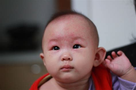 出疹子的症状图片