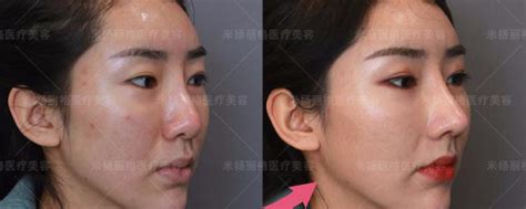 上海哪些医院可以做鼻假体取出?伯思立,薇琳鼻修复案例一览 - 爱美容研社