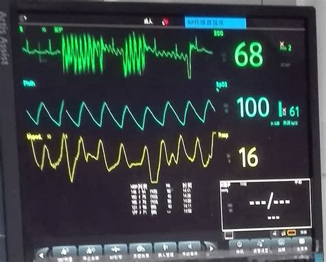 心房颤动与扑动的心电散点图 - 心血管 - 天山医学院
