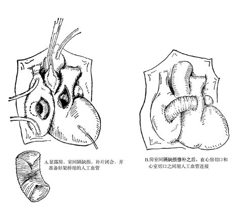 图27-4 Ⅰc型三尖瓣闭锁的手术方法-心血管-医学