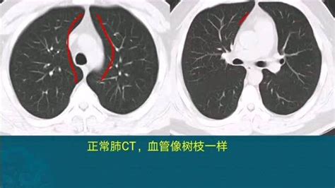 正常胸肺ct图片图解