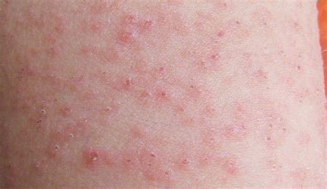 荨麻疹在夏季开始集中爆发-别有病 Byb.cn-纯自然疗法 攻克亚健康