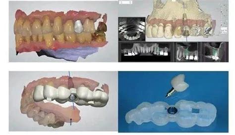 带你深入了解——牙博士数字化种植牙！ - 知乎