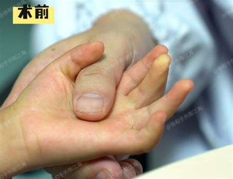 手指伸不直图片