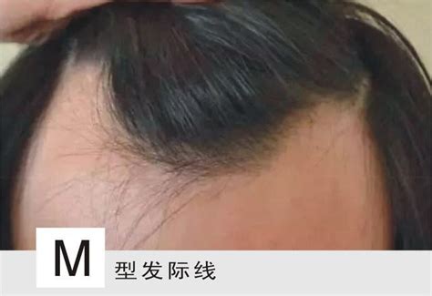 M型发际线的男生，只有这几款发型才能拯救，其他方法的都是浮云|发际线|发型|刘海_新浪新闻