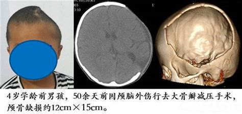 颅骨突出图图片