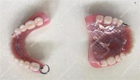 半口活动假牙价格表:半口纯钛假牙2千/半口吸附性义齿1.2万+ - 口腔资讯 - 牙齿矫正网