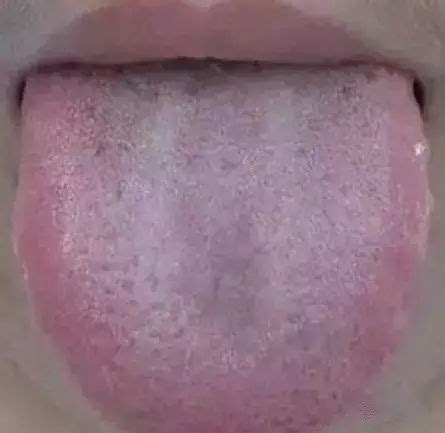 芒刺舌图片