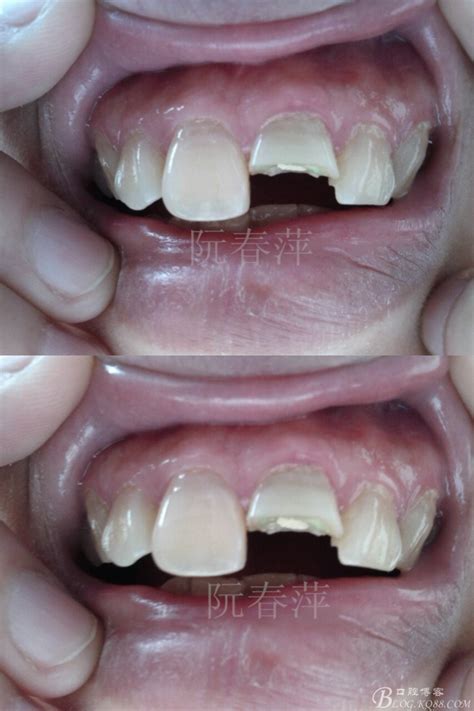 一例门牙外伤冠折烤瓷修复病例-牙医阮春萍的博客-KQ88口腔博客