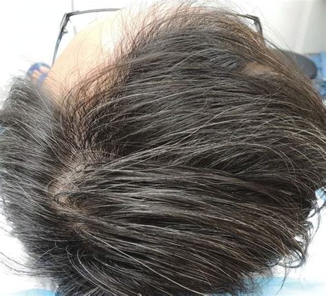 超过30%的小阳人可能会脱发！干细胞帮助30岁阳康男性再生新发