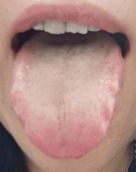 湿气重的舌头图片