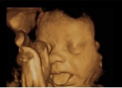 18周胎儿真实图图片