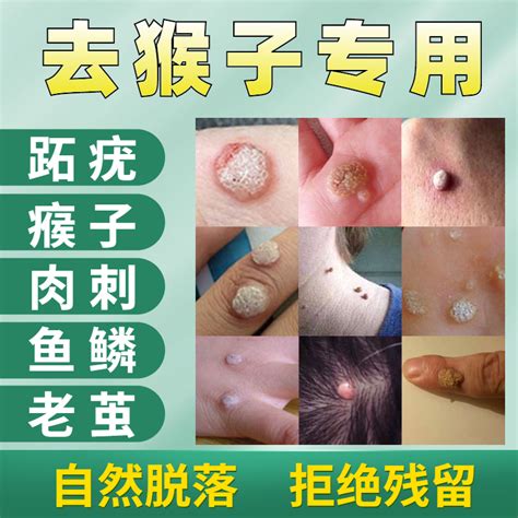 血瘊子图片