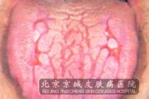 皱襞舌的发病特点是什么_皱襞舌_北京京城皮肤医院(北京医保定点机构)
