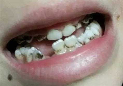 孩子想知道，为什么换牙的时候偶尔会长出双排牙？ - 知乎