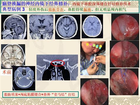 脑脊液鼻漏图片