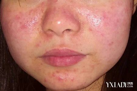 【图】脸上长螨虫的症状图 你的肌肤是否也存在螨虫的疾患呢_脸上长螨虫的症状图_伊秀美容网|yxlady.com