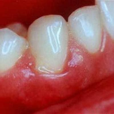 磨牙是什么原因引起的如何治疗(帮你分析了这5个原因，要警惕是“缺钙”)_斜杠青年工作室