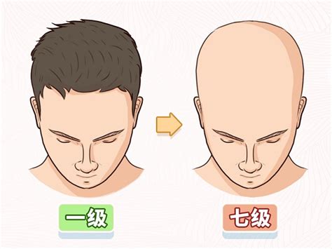 脱发的治疗。头发移植。外科医生在手术室进行头发移植手术。把毛囊从头部的一部分移走的外科技术视频素材_ID:VCG42N1170270275 ...