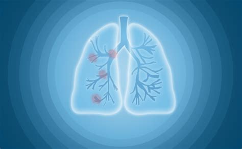 早期肺癌有什么症状？早期肺癌检查项目都有什么-盛诺一家