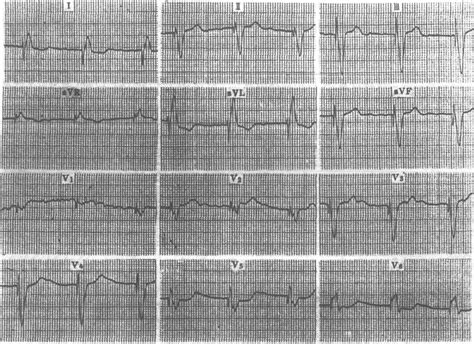 三、心脏起搏方式及起搏心电图特征-临床心电图学及-医学