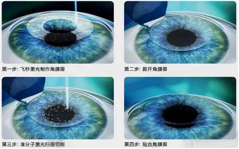 武汉普瑞眼科医院全飞秒价格14800+,可预约关念医生做手术 - 资讯 - 花容眼睛