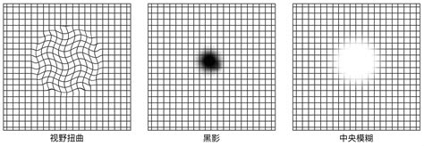 黄斑自测图图片