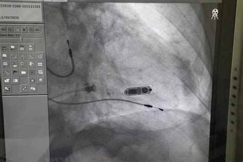 上海市胸科医院同日完成2例复杂心脏病患者Micra无导线起搏器手术_健康_新民网
