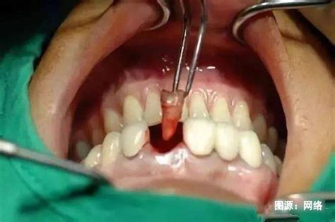 拔牙术后创口的愈合过程_汕头口腔医疗中心