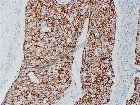 肿瘤标志物科普系列--细胞角蛋白19片段（Cyfra21-1）偏高原因分析 - 知乎