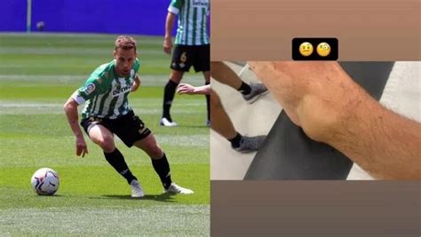 贝蒂斯中场核心发脚踝受伤肿胀照片，批评罗马球员扎尼奥洛下黑脚-直播吧zhibo8.cc