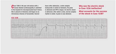 心房颤动与扑动心电图诊断要点 - 好医术早读文章 - 好医术-赋能医生守护生命