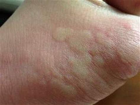 小孩身上荨麻疹图片症状及护理（痒得不行！孩子得了荨麻疹，该怎么办？） | 说明书网