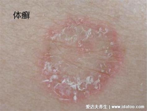 各种皮肤癣图片