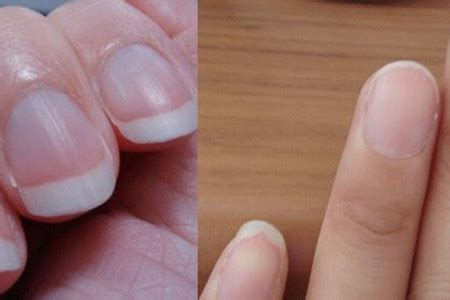 【指甲上有竖纹开裂是怎么回事】【图】指甲上有竖纹开裂是怎么回事 可能是大病的征兆_伊秀健康|yxlady.com