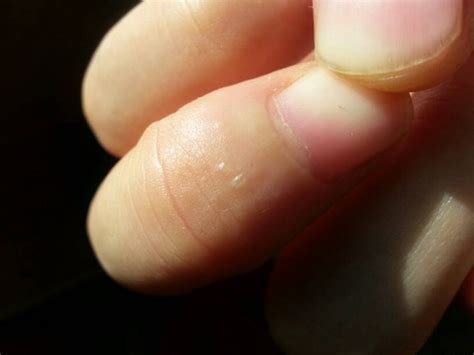 手指水泡型湿疹图片 (5)_有来医生