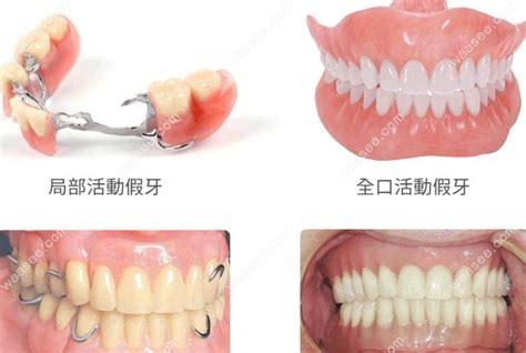半口活动假牙价格表:半口纯钛假牙2千/半口吸附性义齿1.2万+ - 口腔资讯 - 牙齿矫正网