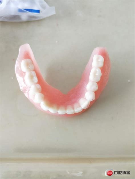 纯钛上颌全口义齿-吴柏康的博客-KQ88口腔博客