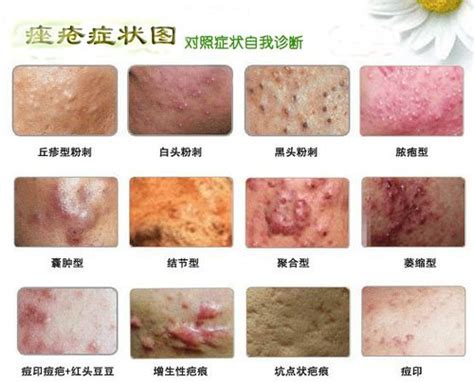 脓疱疮的初期图片