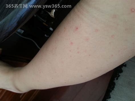 腿上起了很多红色的小点点图片,有五种可能(湿疹早期等)_365养生网