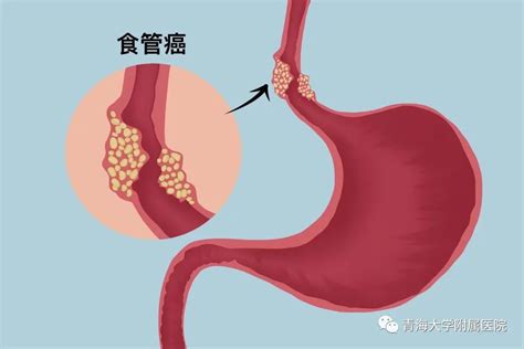 食道图片