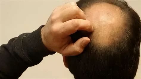 掉头发厉害怎么办如何解决（头发掉的厉害是什么原因？怎样才能摆脱脱发的困扰？） | 说明书网