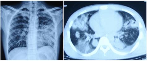 慢阻肺的诊断标准 - 专家文章 - 博禾医生