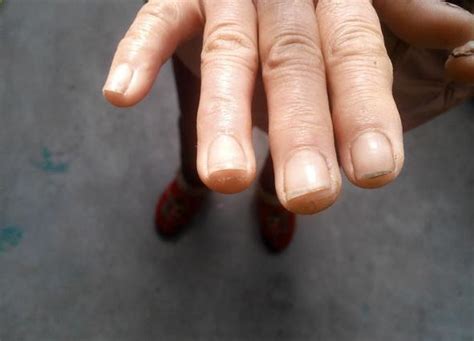 灰指甲用什么药最有效最好能根治（5种治疗灰指甲常用药物详解） | 说明书网