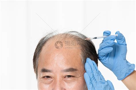 医生给中年大叔治疗秃头高清图片下载-正版图片501661480-摄图网