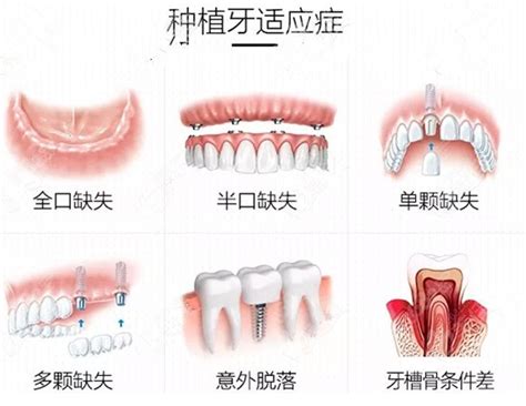 潍坊市种植牙齿哪家医院好？口碑好的牙科排名送给您,牙齿对比照片-8682赴韩整形网