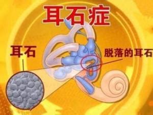 耳石症图片